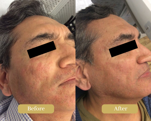 Before and after the PRX-T33 peel